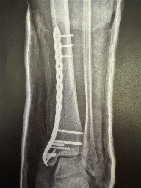 Spiral Fracture Tibia And Fibula R Brokenbones