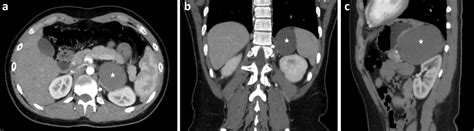 Retroperitoneal Bronchogenic Cyst Imaging And Pathophysiological Review