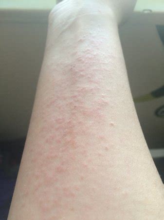 Small Itchy Bumps On Wrist