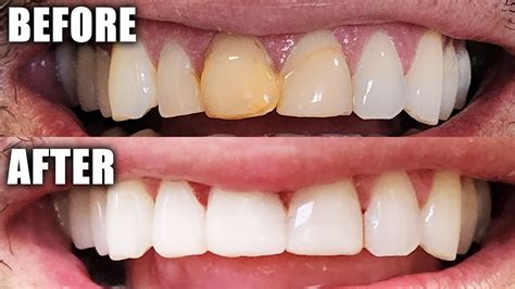 Dentist Performs Full Resin Composite Veneers Procedure Before After