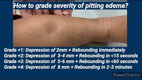 Pitting Edema I Pediatrics Youtube