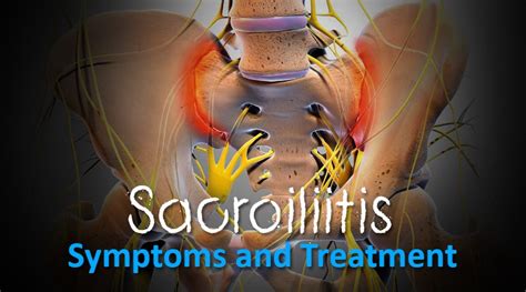 Sacroiliitis Treatments - What is Sacroiliitis and Symptoms