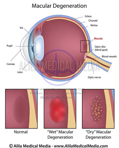 Alila Medical Media Macular Degeneration Medical Illustration