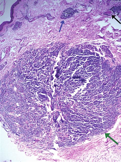 Photomicrograph From The Metastatic Site Showing A Circumscribed Tumour