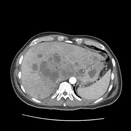 Mass Forming Intrahepatic Cholangiocarcinoma Radiology Case