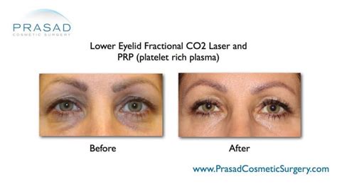 Laser Treatment For Dark Circles Under Eyes Dr Prasad Blog