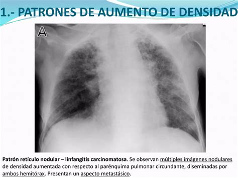 Principales Patrones Radiológicos En La Placa Simple De Tórax Ppt