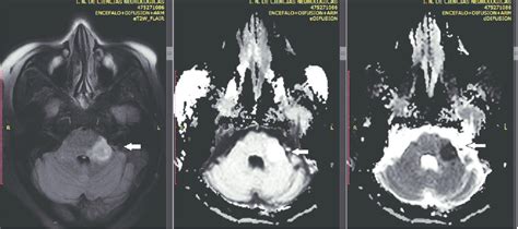 Imagen Por Resonancia Magn Tica Protocolo Flair Difusi N Y Cda
