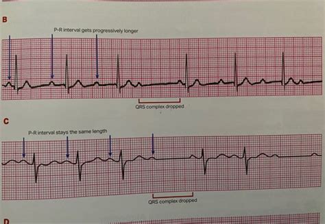 ACLS Flashcards Quizlet