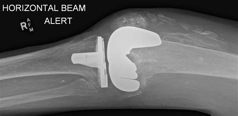 Distal Femoral Periprosthetic Fracture Image