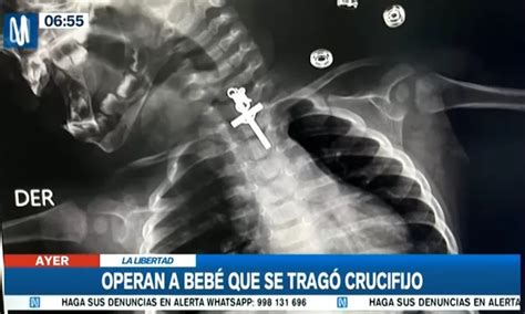 La Libertad M Dicos Operaron Con Xito A Beb Que Trag Crucifijo De