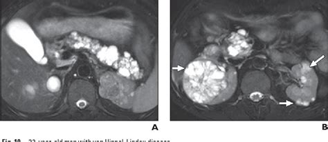 Figure From Typical And Atypical Manifestations Of Serous