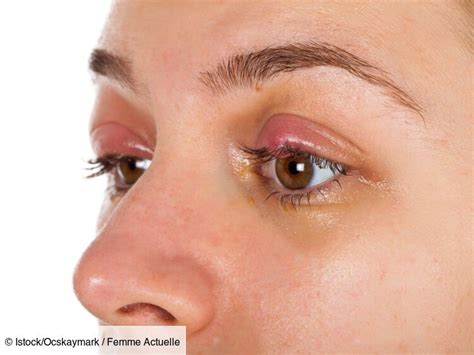 Chalazion Quels Sont Les Traitements Et Comment Le Faire Dispara Tre