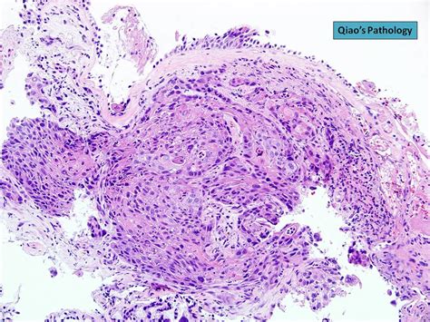 Bronchial Squamous Cell Carcinoma Flickr