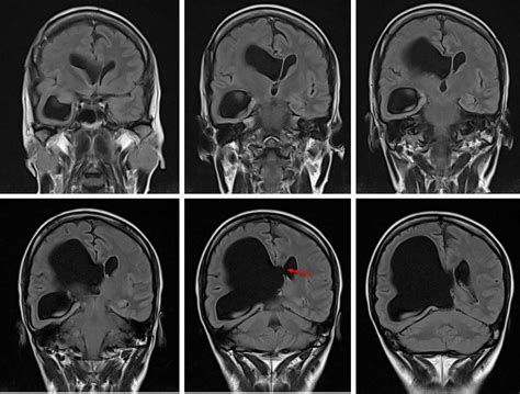 Fenestration For Unilateral Hydrocephalus Radiology Cases