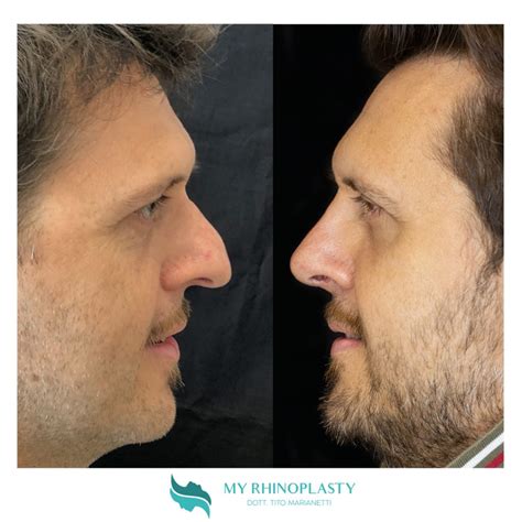 Naso Aquilino Come Correggerlo Con La Rinoplastica My Rhinoplasty