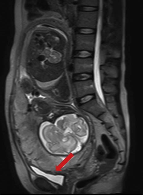 Coexisting Placenta Accreta And Placenta Previa Sagittal Mr Image Download Scientific Diagram