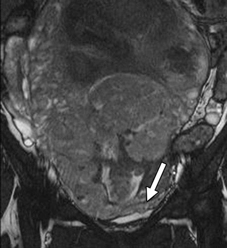 A Pictorial Review Of Postpartum Complications Radiographics