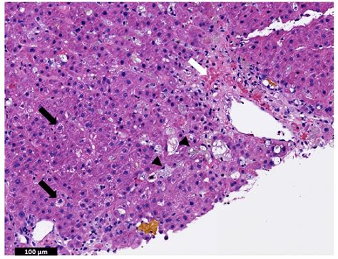 Lobular And Hepatocyte Injury Hepatocyte Swelling Black Arrows And