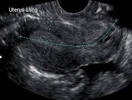 Diagnosi Del Fibroma Uterino Dr Tommaso Lupattelli