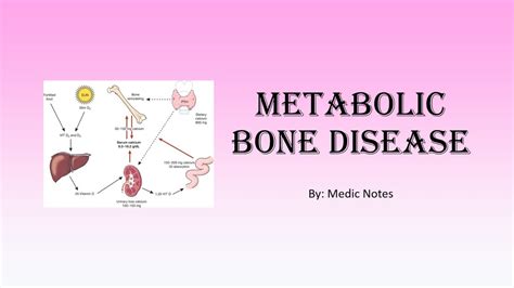 Metabolic Bone Disease Rickets Osteomalacia Paget S Disease