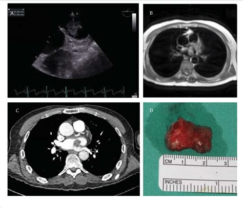 Atoe Mass From The Coumadin Ridge B Mri Enhances The Pfe In The