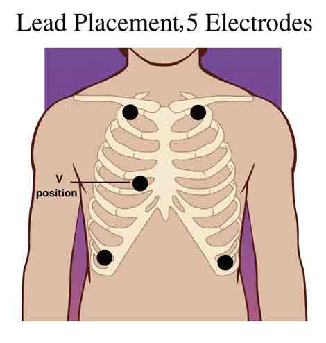 Cardiac Monitor 5 Lead Telemetry Placement