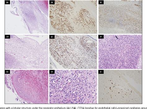 Figure 1 From Management Of Nasal Lobular Capillary Hemangioma With