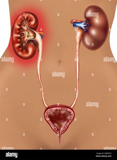 Pyelonephritis Kidney Infection Stock Photo Alamy