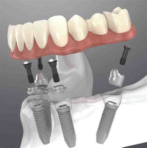 How Dental Implants Work Dental News Network