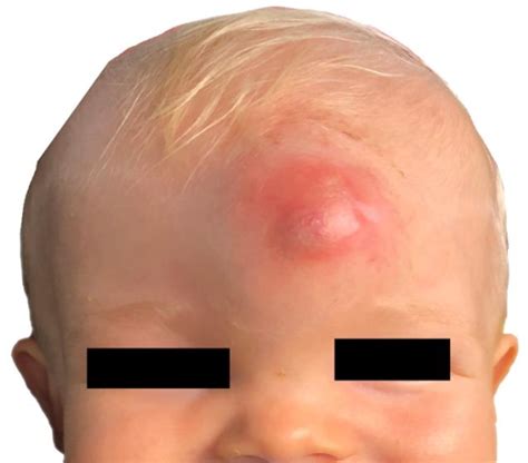 Figure 1 From Craniofacial Dermoid Cyst A Case Report Semantic Scholar