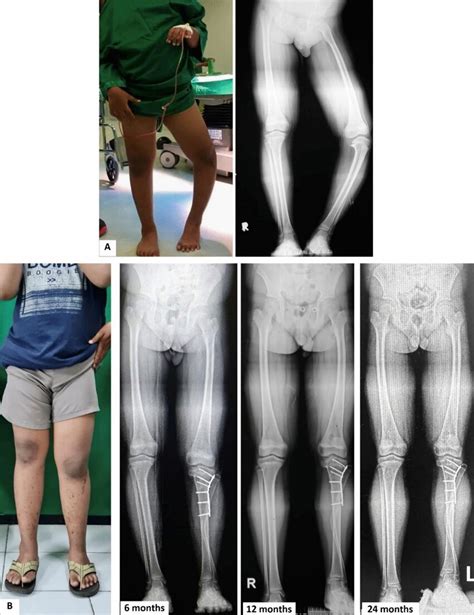 Preoperative And Postoperative Results Of A Year Old Male With