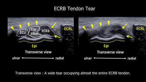 Extensor Tendon Ultrasound