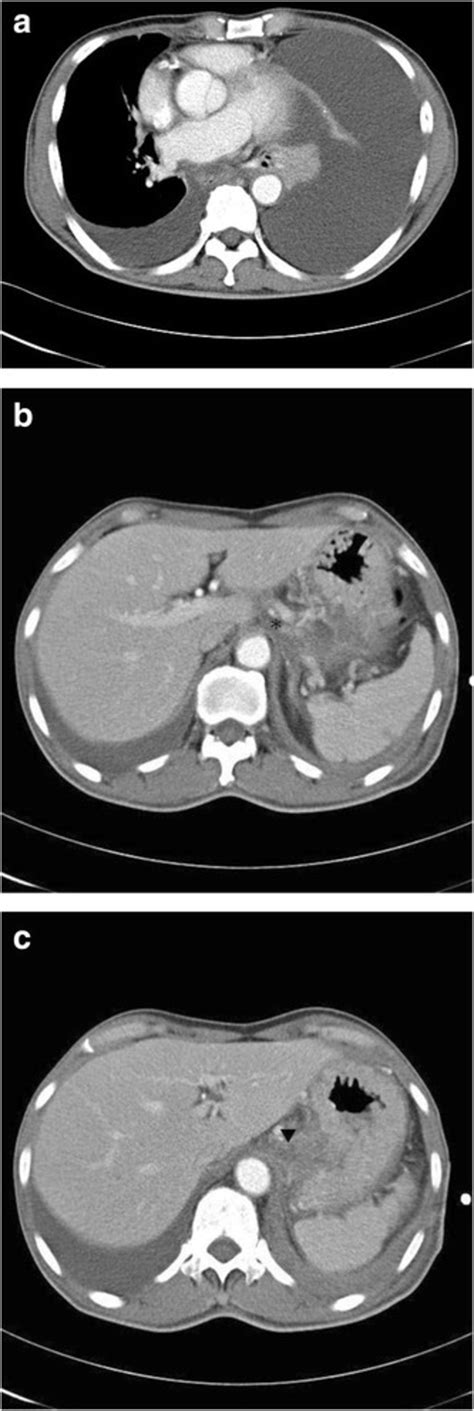 Computed Tomography Scans Of The Chest And Abdomen A The Computed