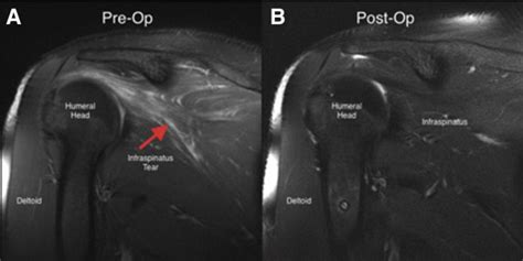 Arthroscopic Intramuscular Side To Side Repair Of An Isolated