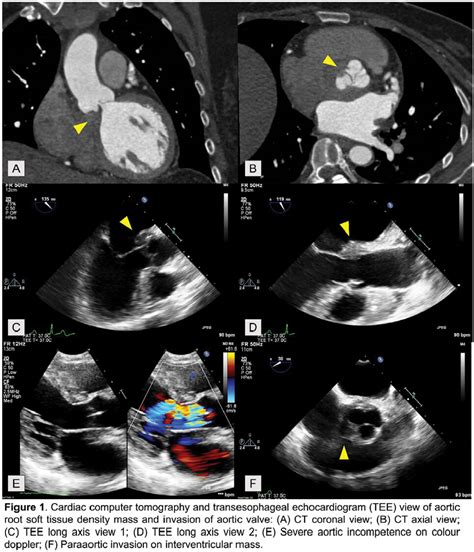 Severe Aortic Incompetence From Igg4 Related Disease Associated