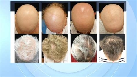 Fda Approves Use Of Olumiant To Help Treat Severe Alopecia Areata Gma