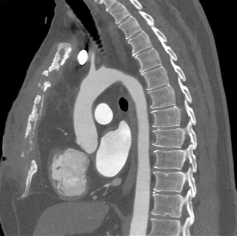 Sternal Osteomyelitis With Inflammation Musculoskeletal Case Studies