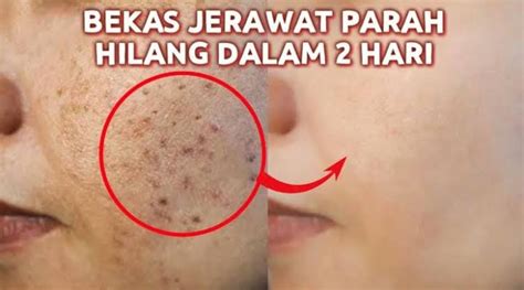 5 Cara Mudah Menghilangkan Bekas Jerawat Pakai Bahan Alami Wajah Jadi