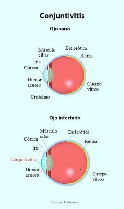 Conjuntivitis Viral Bacteriana Síntomas Contagio Tratamiento Casero