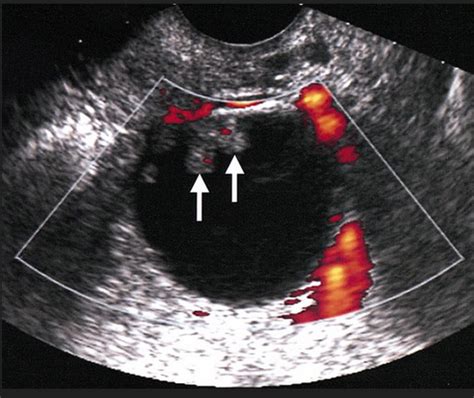 Studying Medicine On Twitter Ovarian Cancer Ovarian Malignant