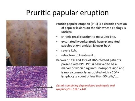 Cutaneous Manifestations Of Hiv Infection