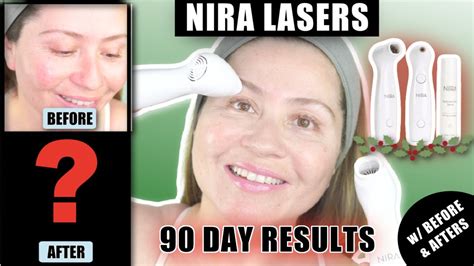 NIRA LASERS 90 DAY BEFORE AFTER RESULTS YouTube