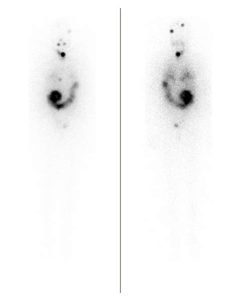 A Initial I 131 Whole Body Scan Revealing Two Focal Areas Of