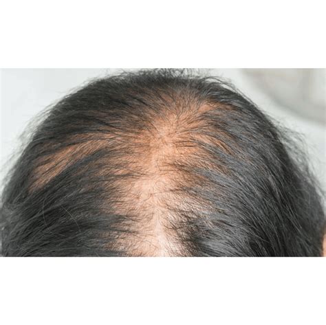 Female Pattern Baldness Trua