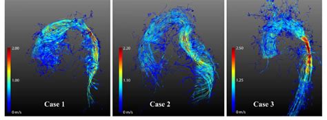 4d Mri Based Colour Coded Velocity Magnitude Streamlines At The Peak