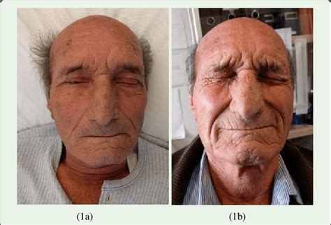 The Patients Clinical Presentation With Bilateral Facial Nerve Palsy Download Scientific