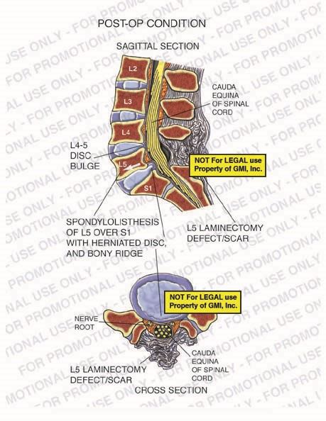 Post Op Condition 97020c14a Generic Medical Legal Exhibits A Division Of Mvi