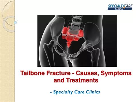 PPT - Tailbone Fracture - Causes, Symptoms and Treatments PowerPoint ...