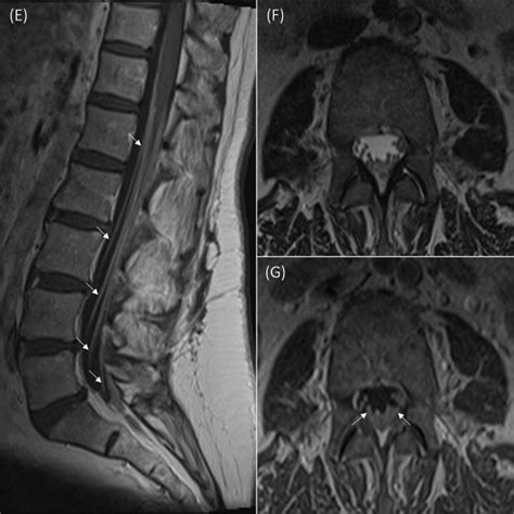 Sagittal T1 Post Gadolinium Mri Lumbar Spine E Showing Smooth